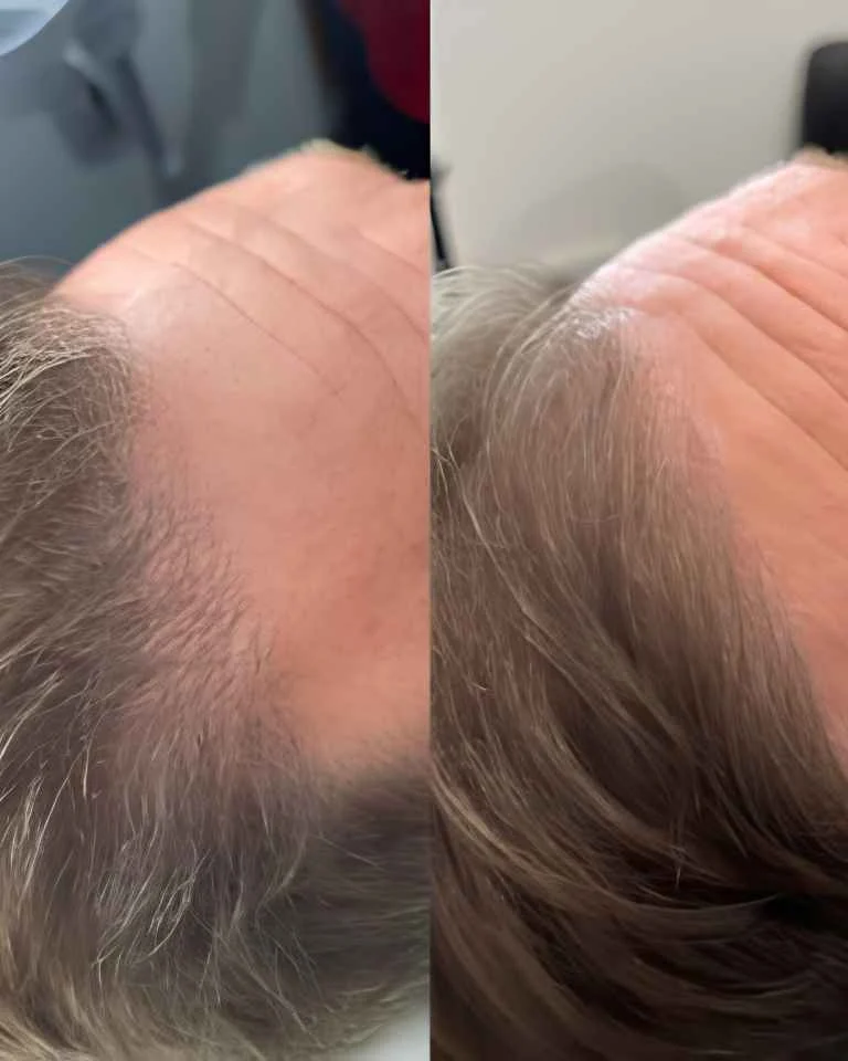 Scalp micro-needling and hair restoration treatment at Enhance Me Aesthetics clinic in Essex