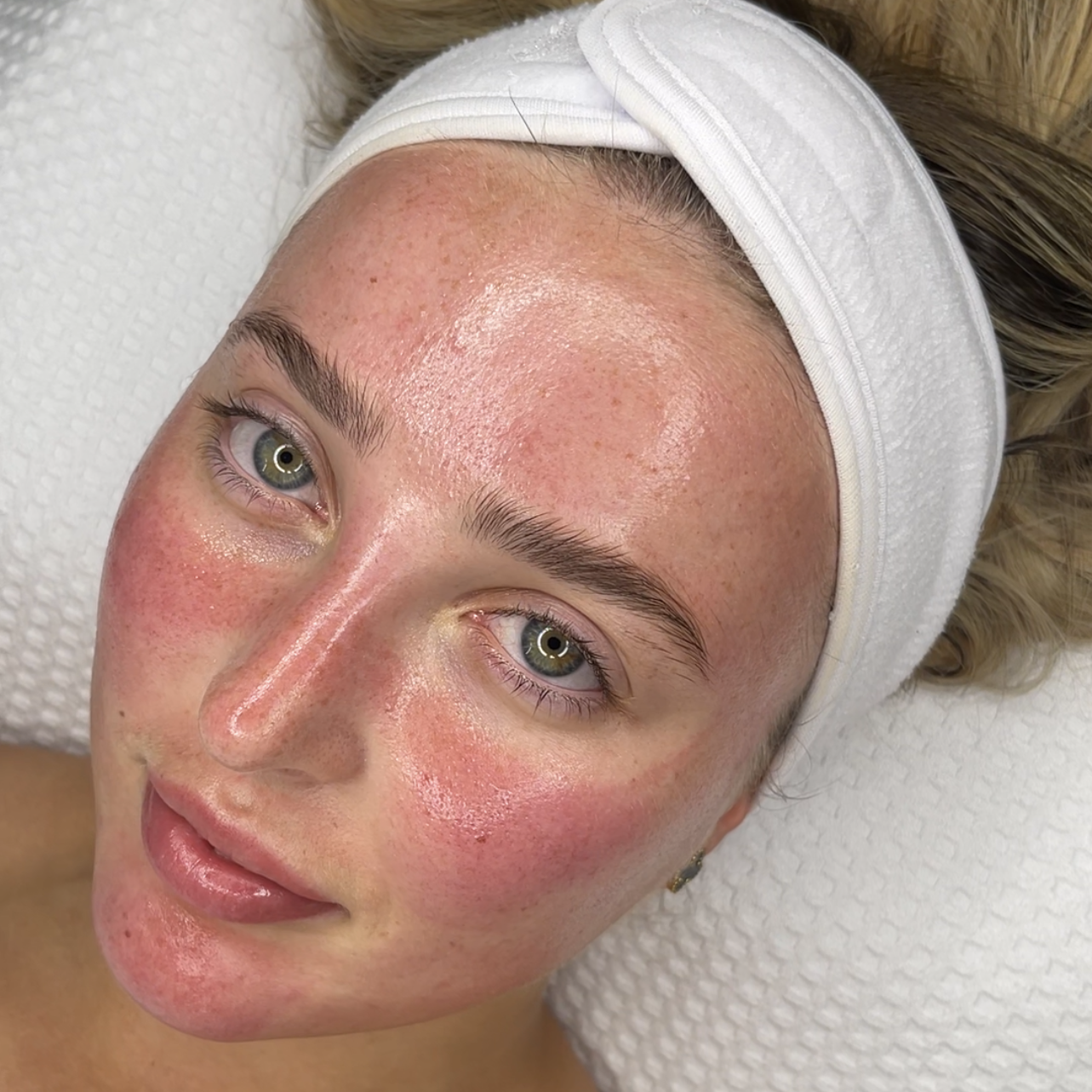 lient receiving a glass skin facial treatment for hydra hydration and smooth texture at Enhance Me Aesthetics in Essex