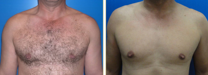 hair removal alma 1