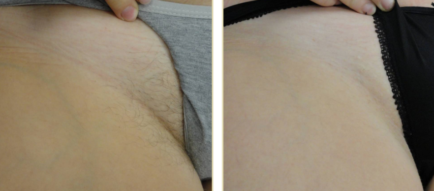 hair removal alma 2