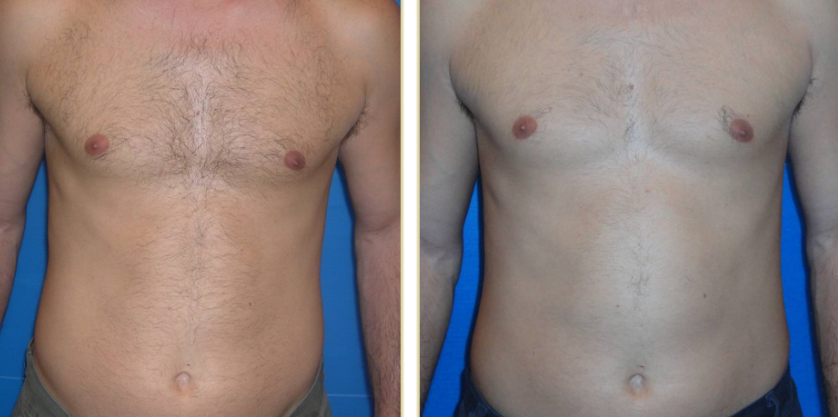 hair removal alma 3