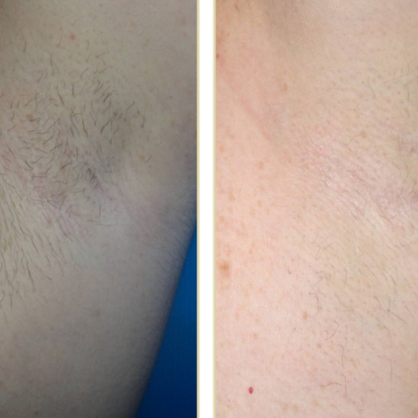 hair removal alma 4