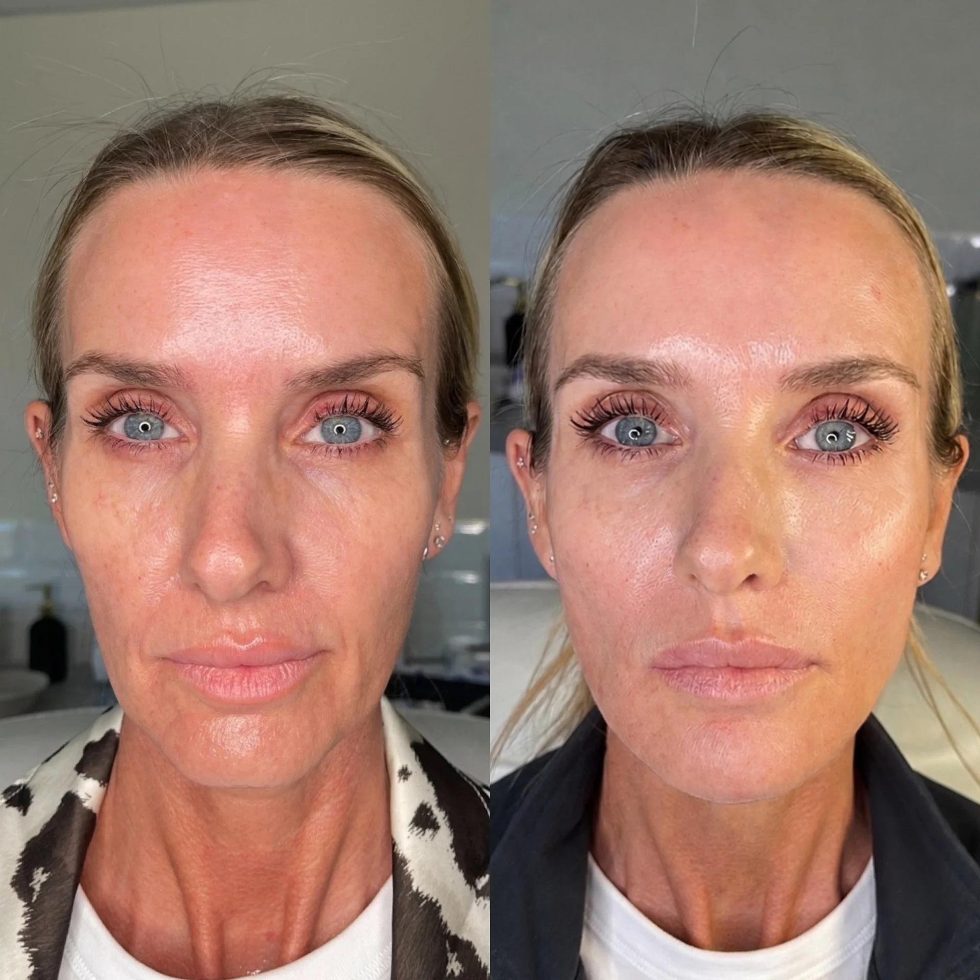 Before and after Radiesse biostimulator treatment showing improved cheek volume, jawline definition, and under-eye smoothing at Enhance Me Aesthetics Essex.