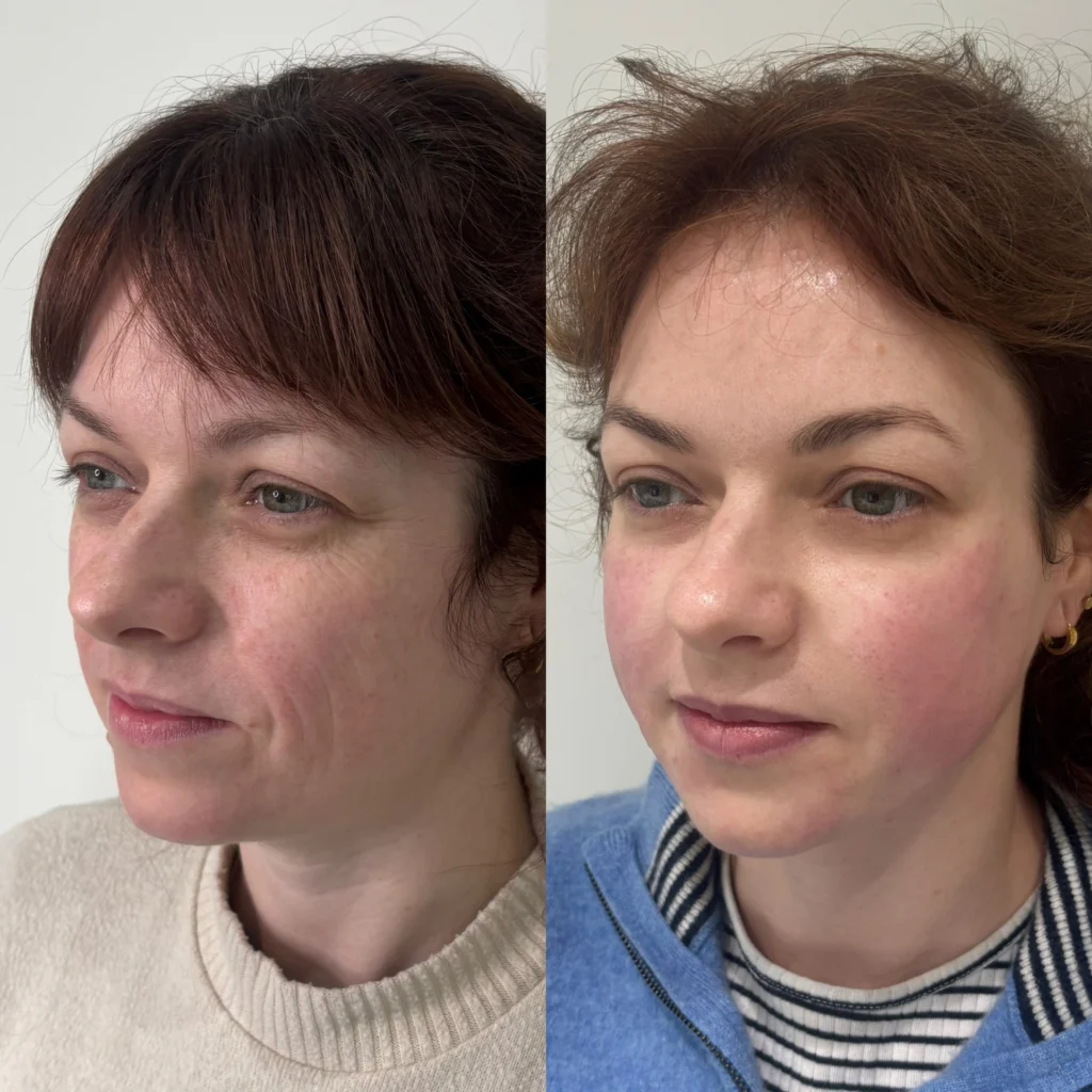Autumn and winter skin rejuvenation at Enhance Me Aesthetics near Colchester, Essex.