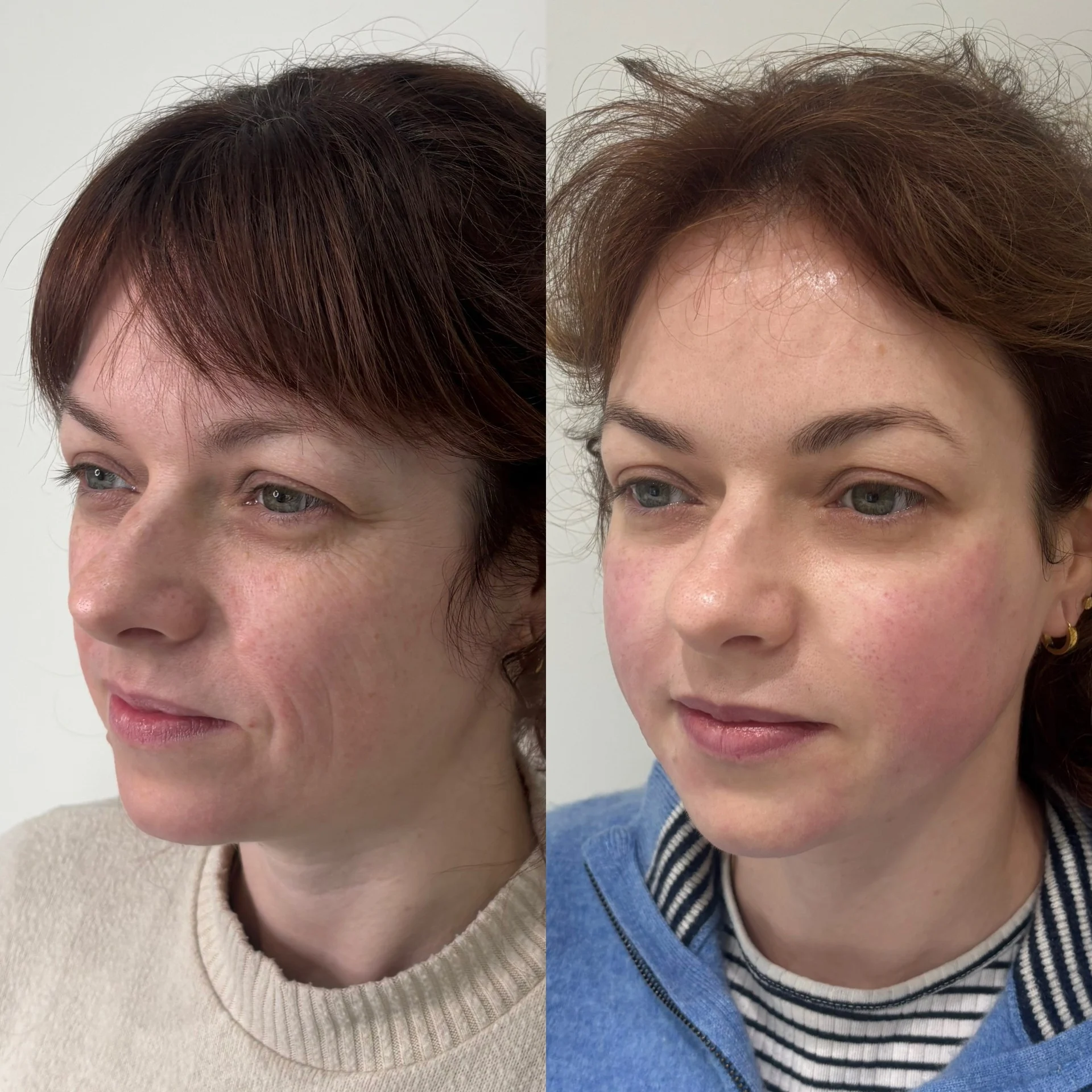 Autumn and winter skin rejuvenation at Enhance Me Aesthetics near Colchester, Essex.