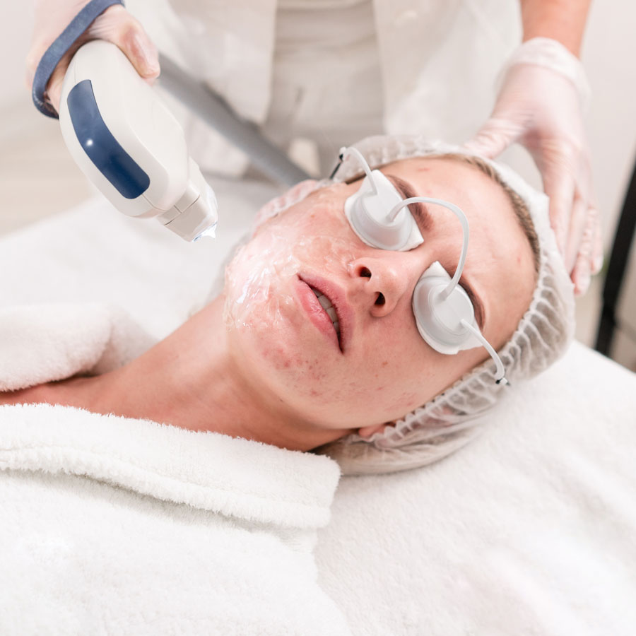 IPL Facial for Acne IPL Facial for Acne