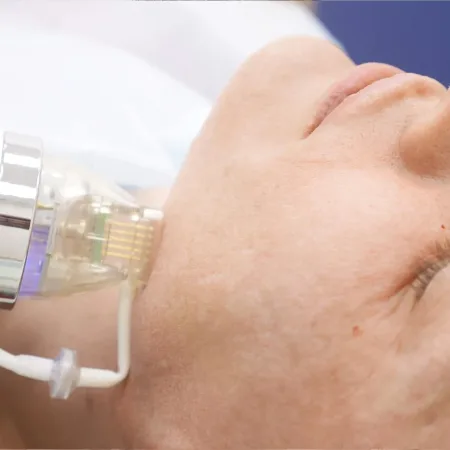 RF-microneedling-4378-scaled