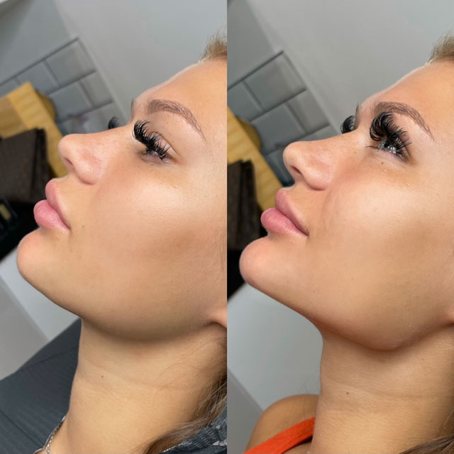 Jawline & Lower Face Lifting